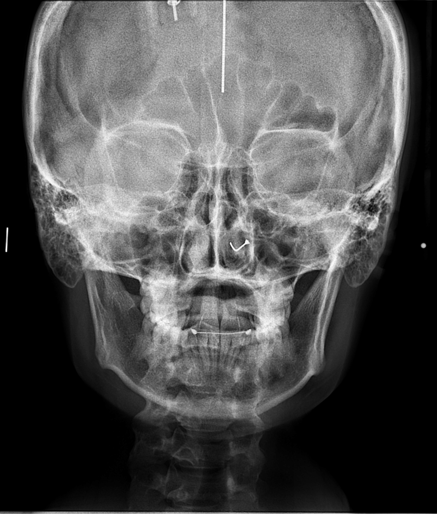 Frontal